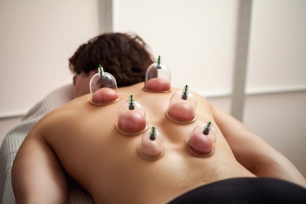 How Cupping Therapy Can Help With Pain Management